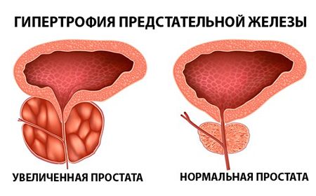 нормальная и увеличенная простата
